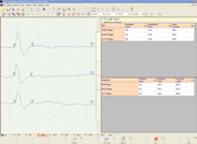 SNCVSensoryNerveConductionVelocityAntidromicBIG.gif
